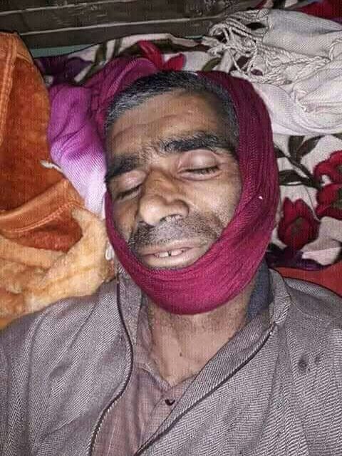 Civilian Injured In Shopian Gunfight Succumbs After 27 Days