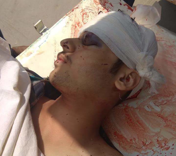 Civilian Wounded In Shopian Clashes Succumbs