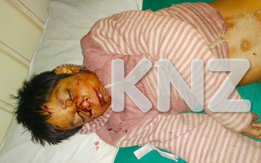 Minor Boy Critically Injured In Road Accident In Ganderbal