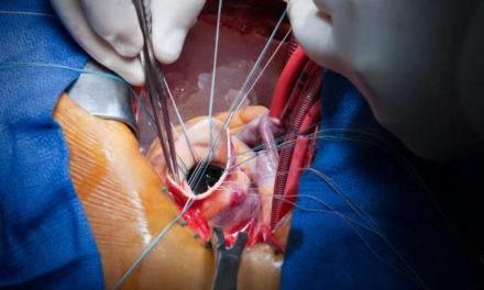 In a first, doctors at SKIMS replace heart valve of nine-year-old girl