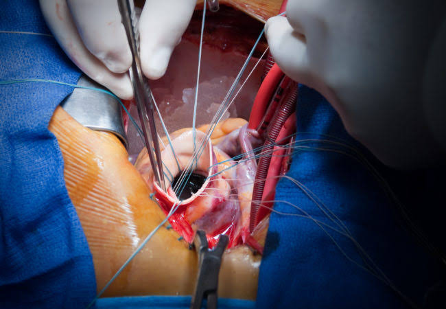 In a first, doctors at SKIMS replace heart valve of nine-year-old girl