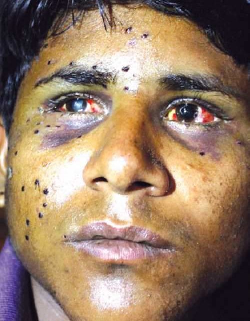 Non-local labourer hit by pellets, blinded in right eye
