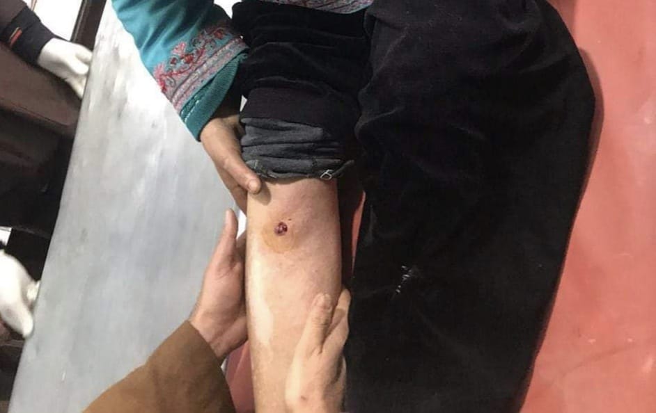Woman recieves bullet injury, locals protest in Budgam village