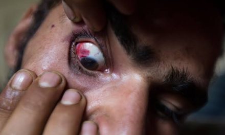 Shopian Encounter: Youth suffers pellet injury in eye in Shopian, hospitalized