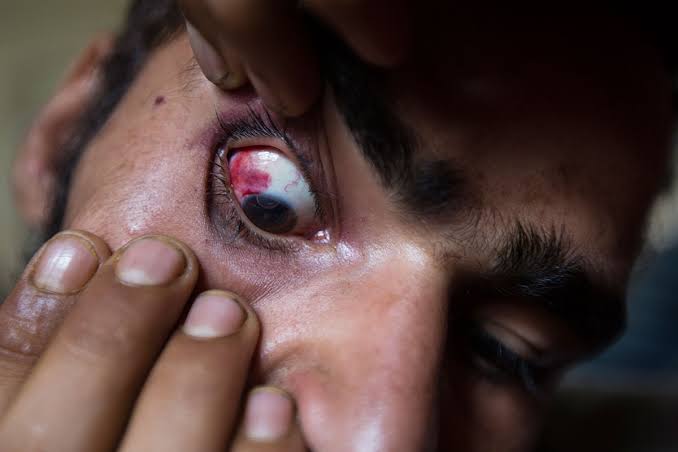 Shopian Encounter: Youth suffers pellet injury in eye in Shopian, hospitalized