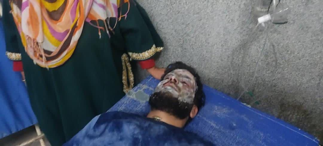 2 Technicians Sustain Burn Injuries in Oxygen Plant Leakage in GMC Baramulla