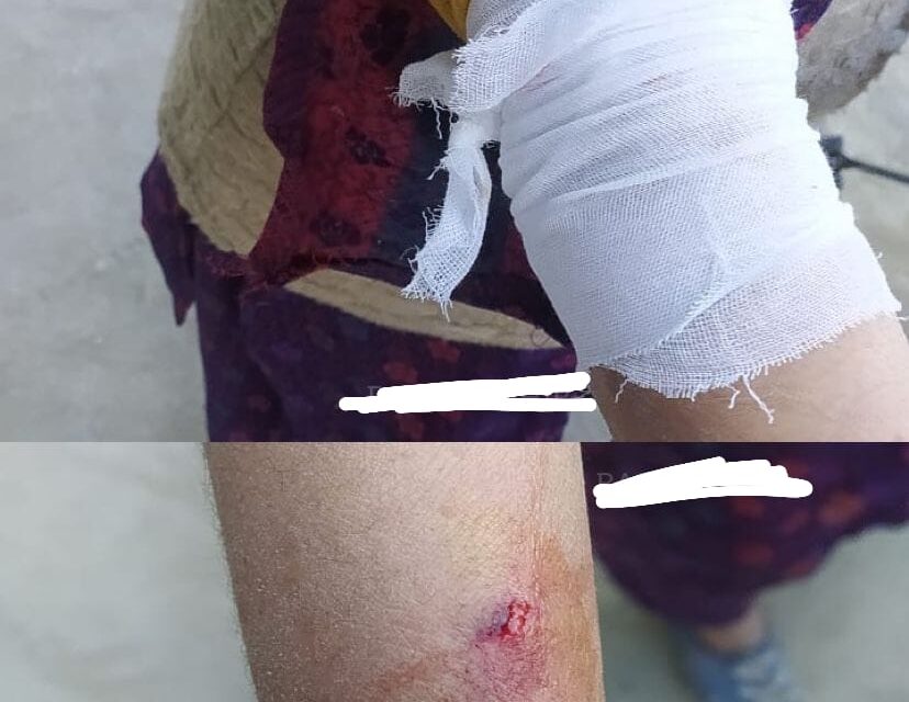 54-yr-old woman injured in leopard attack at Gbl