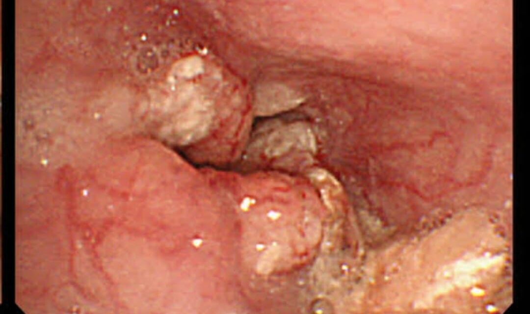 Dr Mir Samiullah performs complex surgery for cancer of esophagus