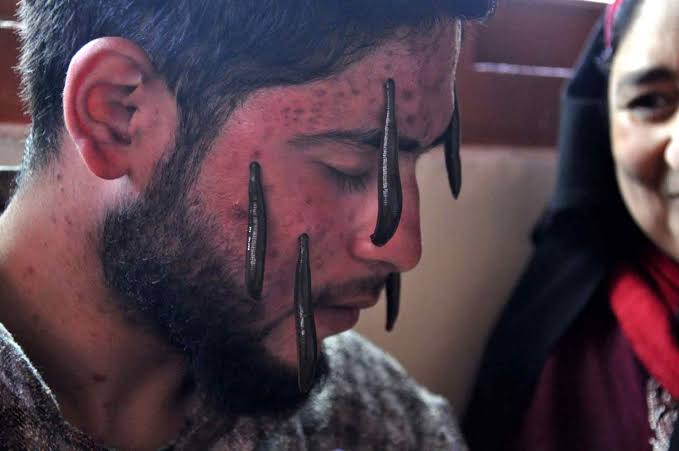 Beelines for leech therapy on Novroz Eve