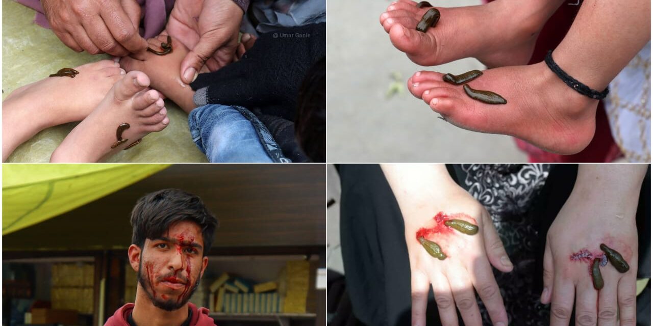 Kashmir On ‘Navroz’ hundreds let leeches suck their blood in hope of getting rid of long-time aliments